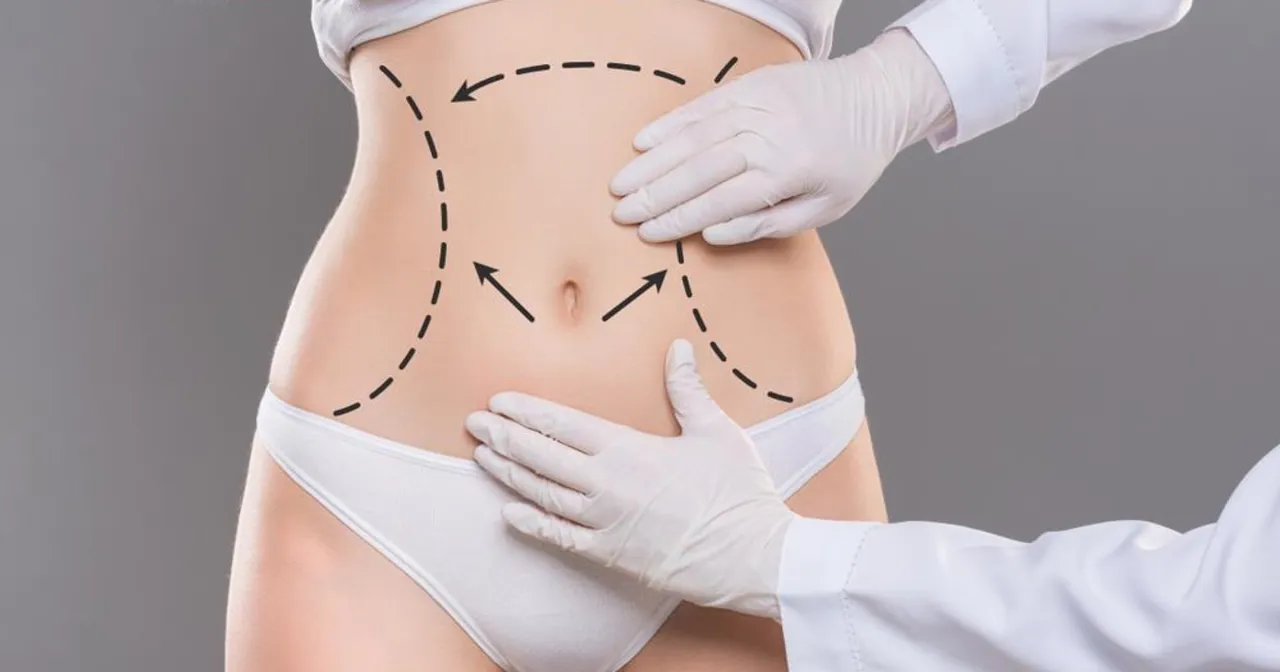 przebieg liposukcji, schemat odsysania tłuszczu