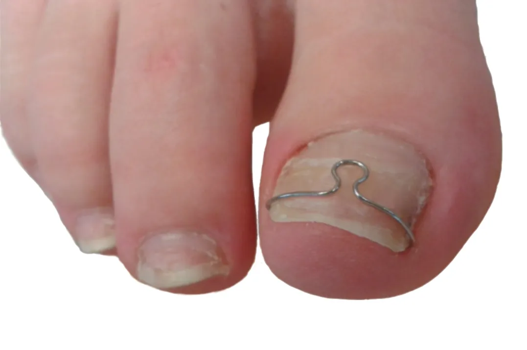 klamry ortonyksyjne rodzaje