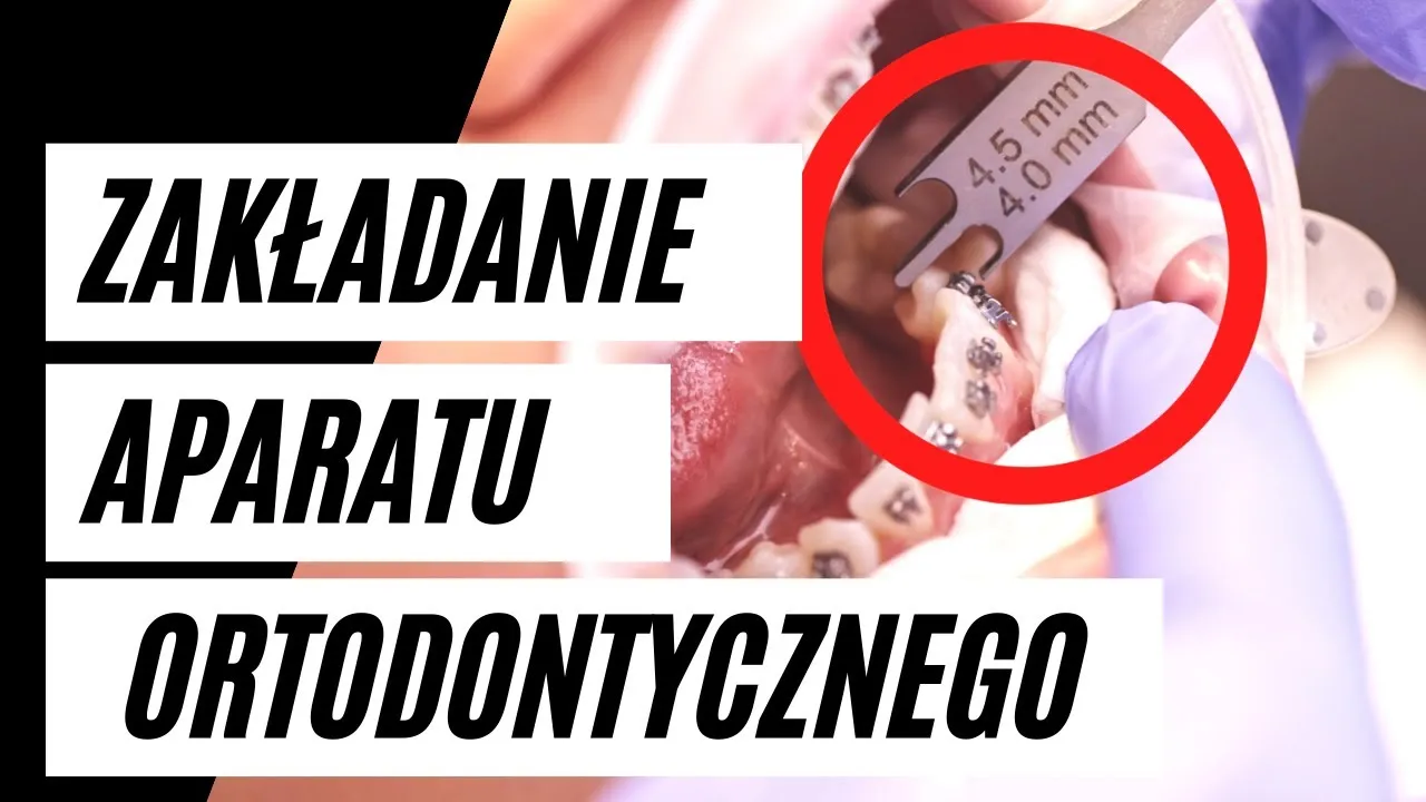 Zakładanie aparatu ortodontycznego krok po kroku