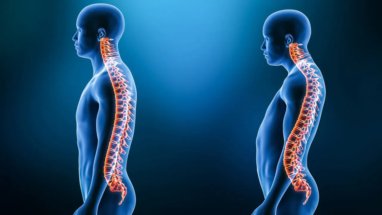 mechanizm powstawania lordozy lędźwiowej