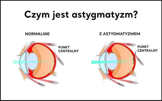 astygmatyzm rogówka nieregularny kształt vs normalne oko