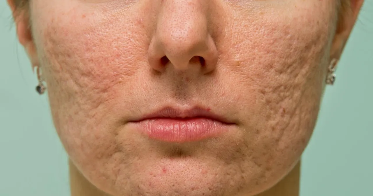 Pielęgnacja cery trądzikowej