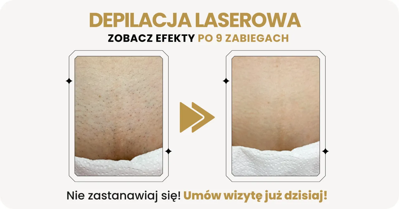 Depilacja laserowa bikini: przed i po 9 zabiegach. Zobacz, jaka depilacja bikini najlepsza dla Ciebie! Umów wizytę.