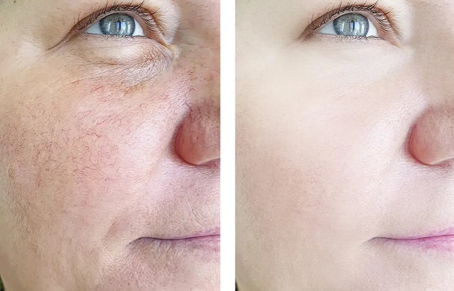 laserowe zamykanie naczynek efekty