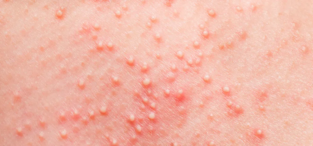 Rodzaje wysypek alergicznych na sk&oacute;rze