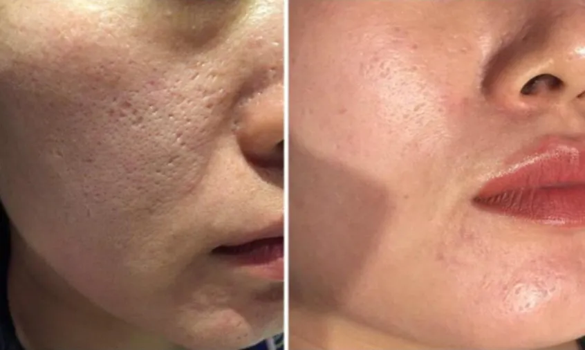 Por&oacute;wnanie zabieg&oacute;w na blizny potrądzikowe