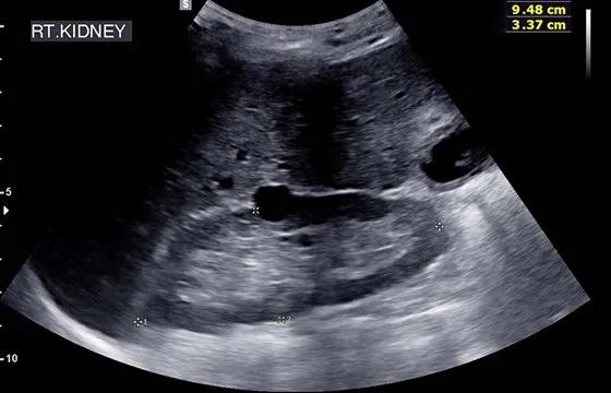 USG układu moczowego