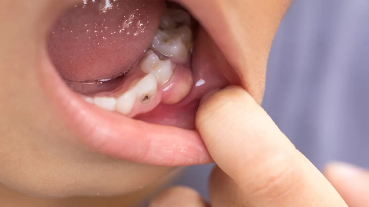 ropień na dziąśle wygląd zdjęcia