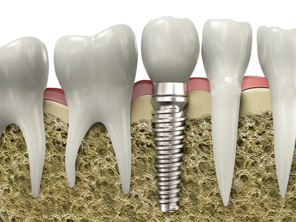 Zdjęcie Co to jest implant zęba? Wszystko, co musisz wiedzieć o korzyściach i procesie implantacji