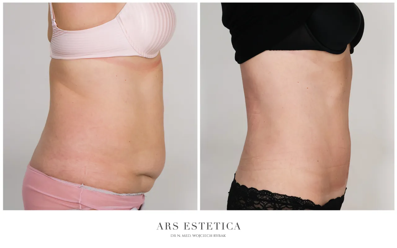 por&oacute;wnanie metod liposukcji