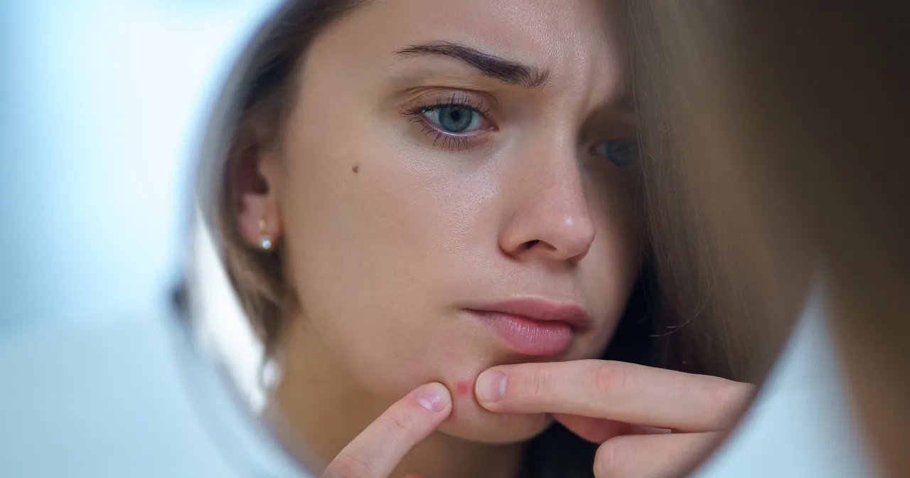 Zmarszczki na czole i pryszcz na brodzie. Jak szybko usunąć pryszcz?