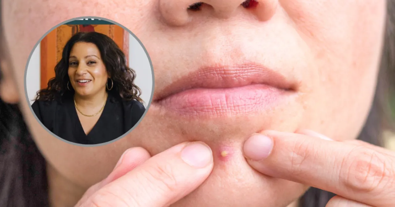 maści i kremy na wyciśnięty pryszcz