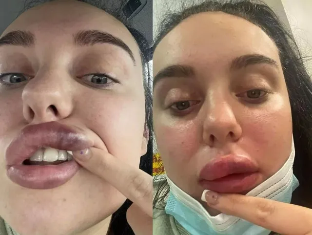 kobieta unika schylania po zabiegu estetycznym