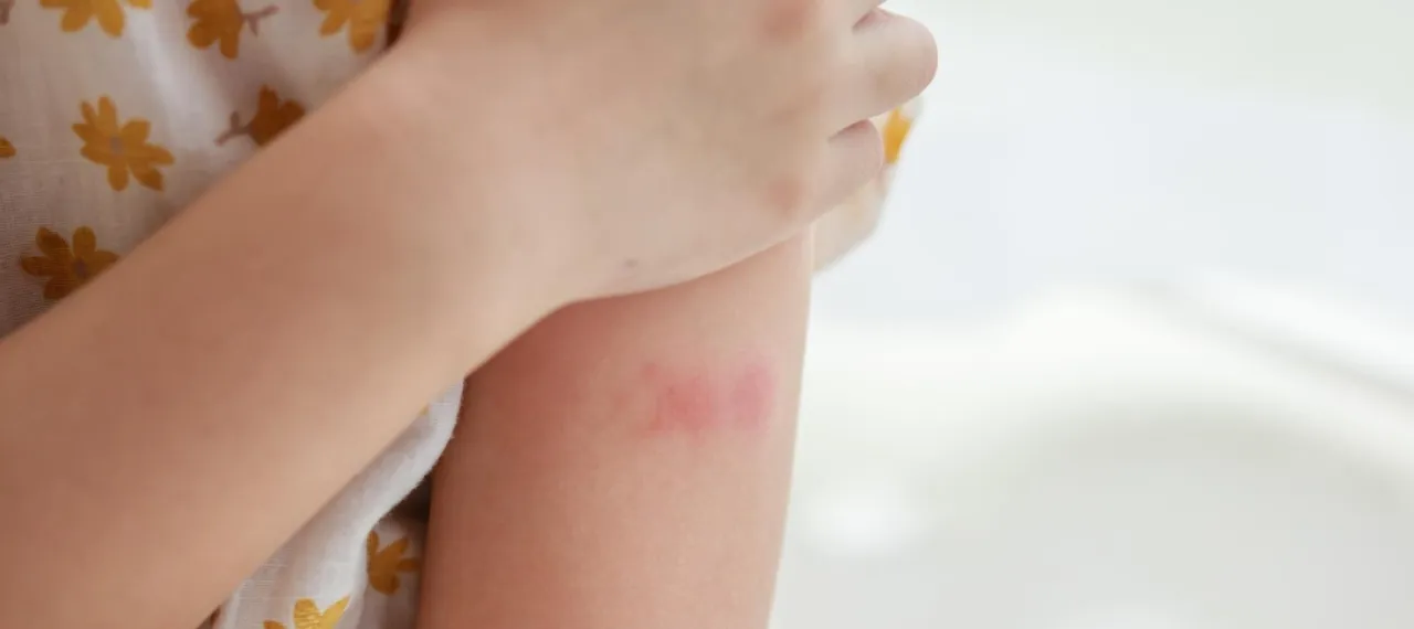rumień wędrujący u dziecka zdjęcia