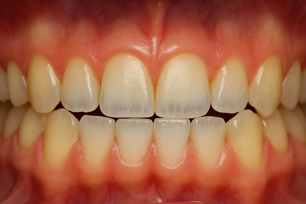 zęby przed i po uszkodzeniu szkliwa przez kwasy