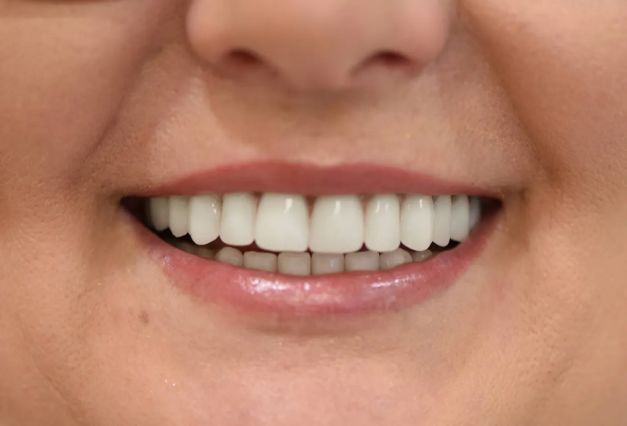 Uśmiechnięta osoba z implantami zęb&oacute;w