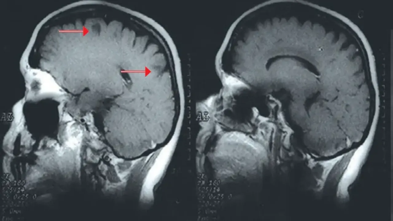 migrena m&oacute;zg neurologia