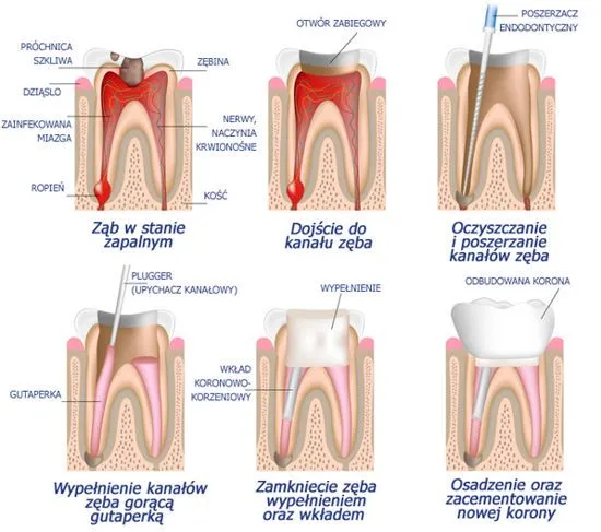 perforacja kanału zęba schemat