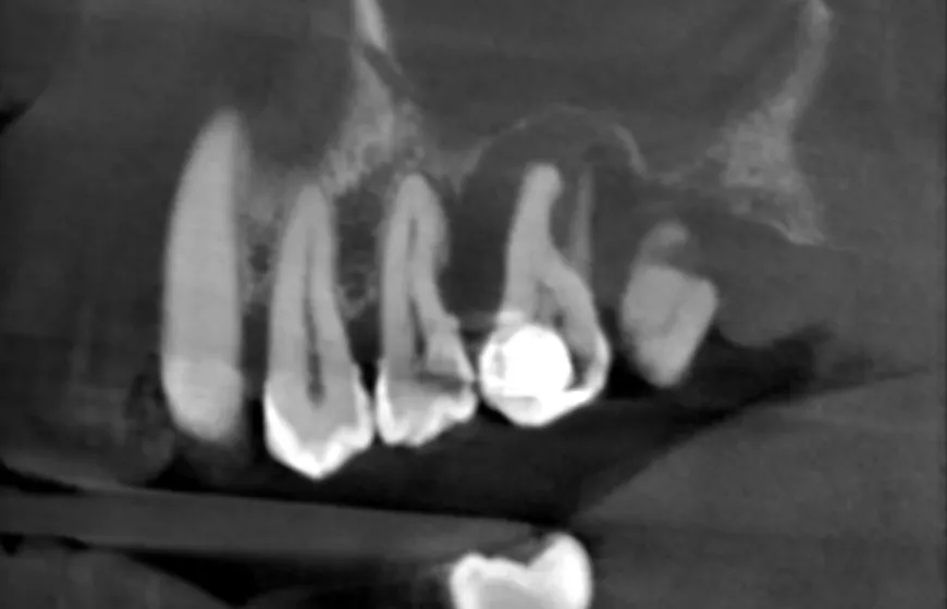 zdjęcie rentgenowskie zęba z zgorzelą