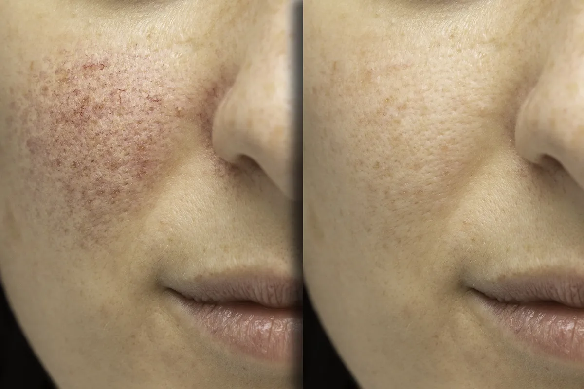 profesjonalne zabiegi na cerę naczynkową