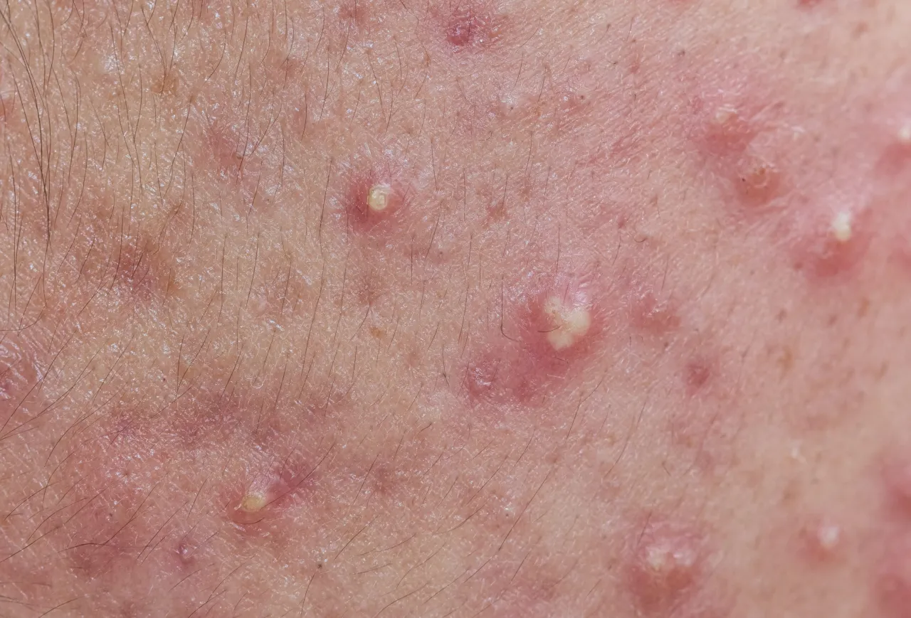 dojrzały pryszcz z białym czubkiem