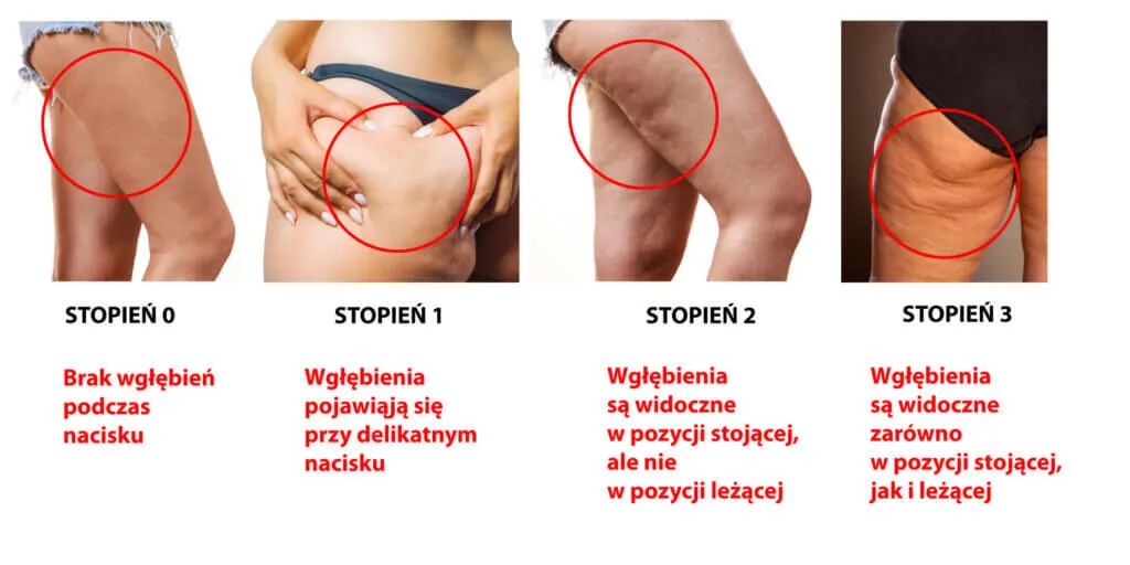 Rodzaje cellulitu porównanie wizualne