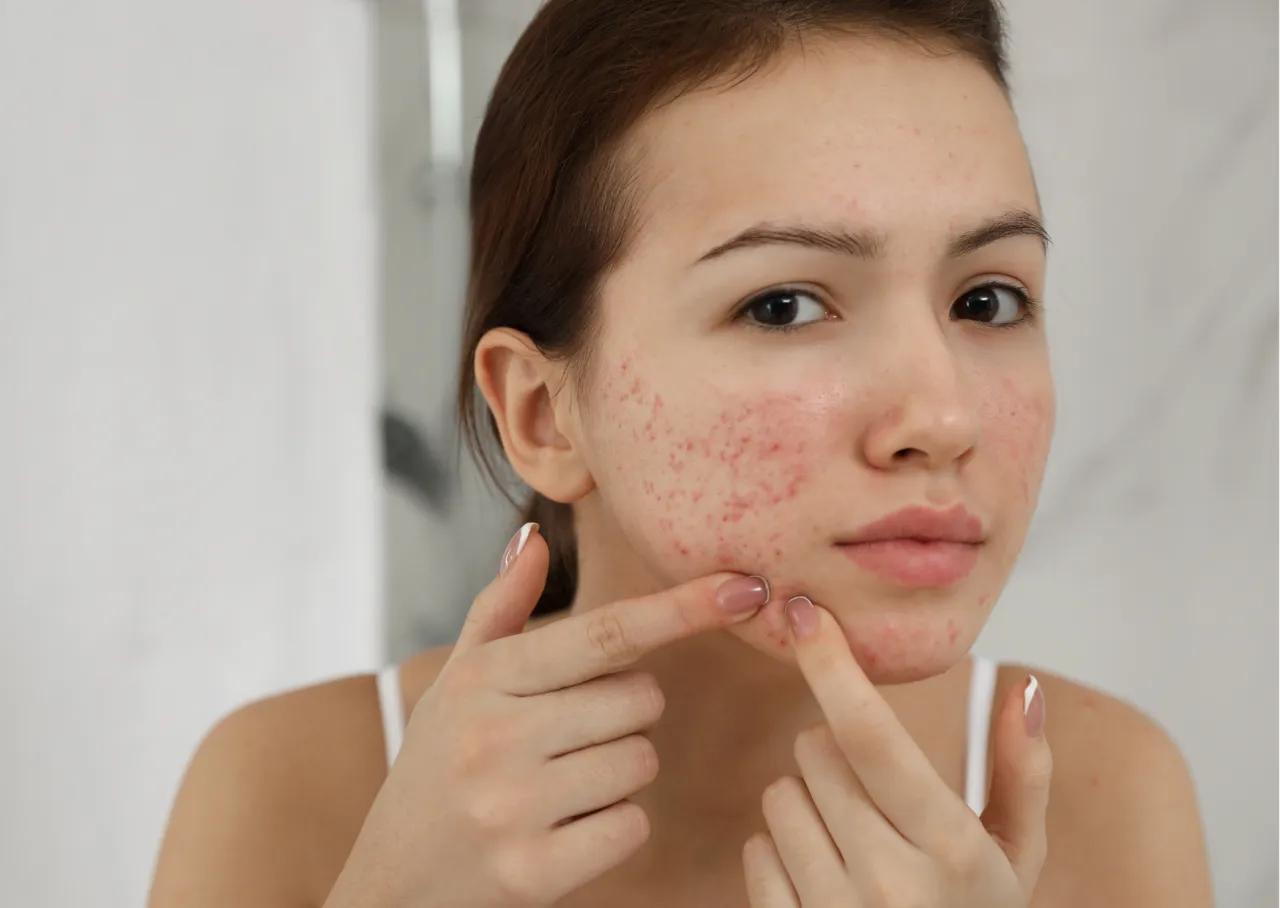 Dermatolog leczenie czerwonych plam po trądziku