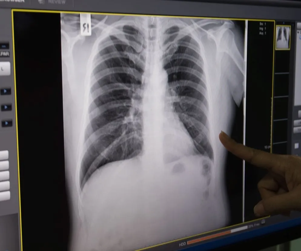 objawy złamania żebra infografika