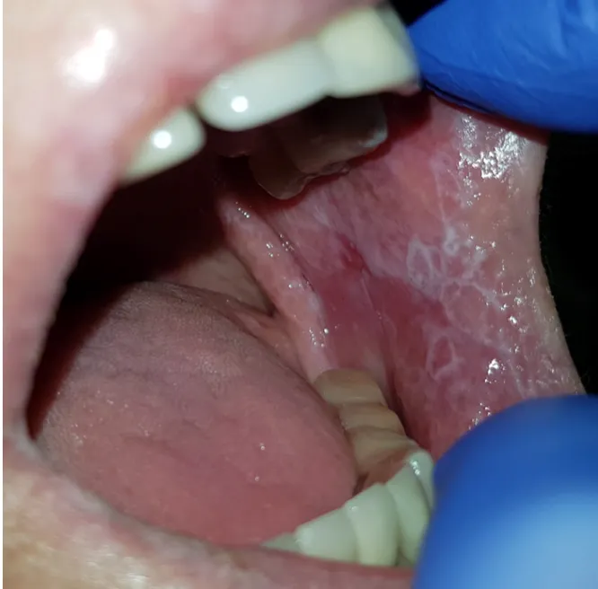 liszaj płaski jama ustna objawy zdjęcia