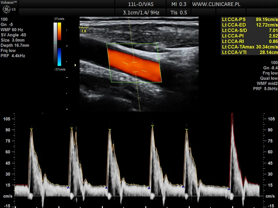USG Doppler tętnic szyjnych