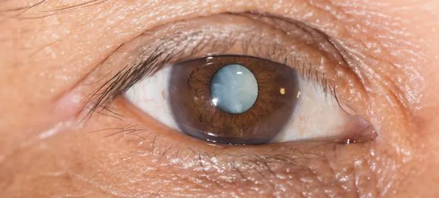 Zdjęcie Czym jest zaćma wtórna? Objawy, przyczyny i metody leczenia