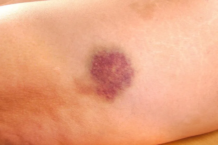 Zdjęcie Zaburzenia hematologiczne co to - objawy, przyczyny i leczenie