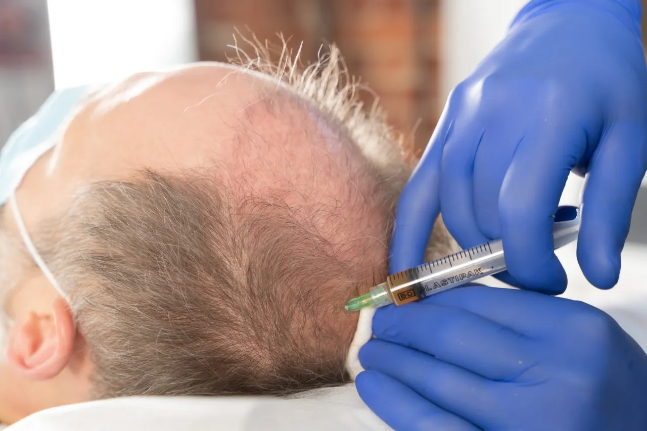 Terapia osoczem bogatopłytkowym proces regeneracji