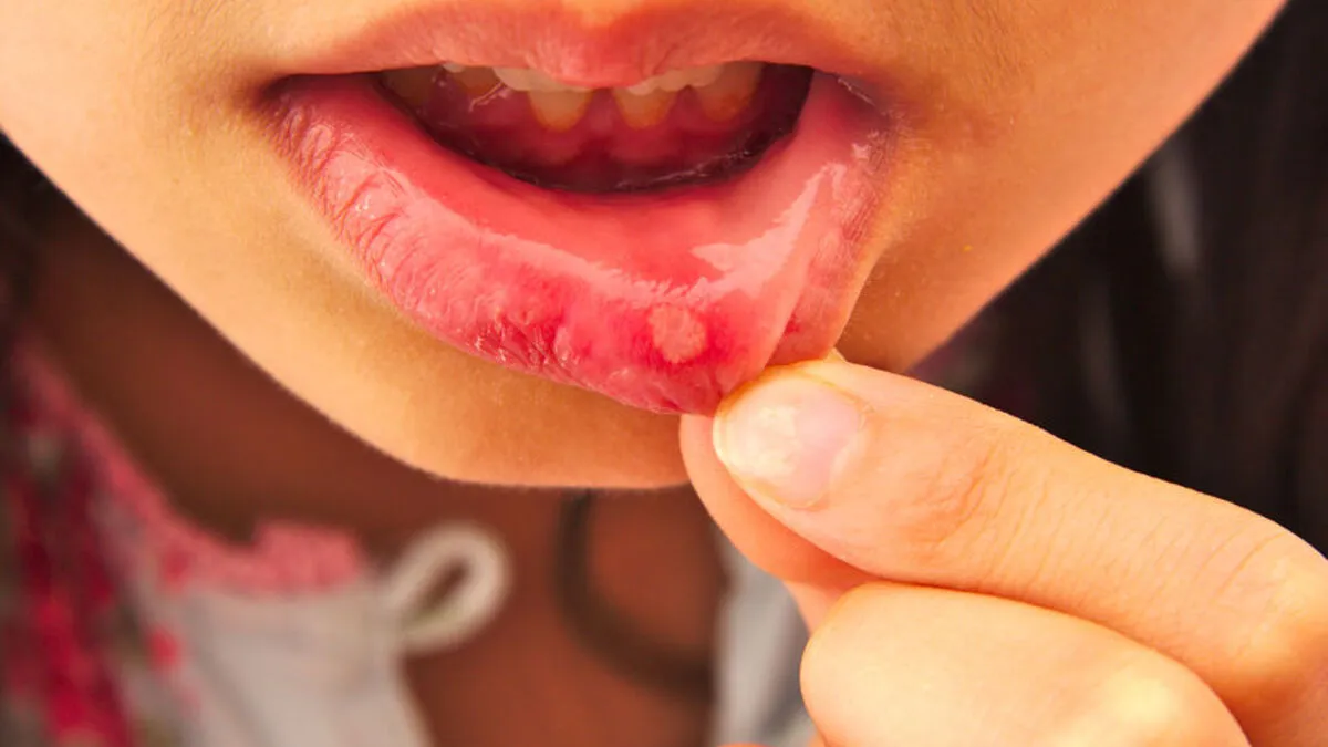 objawy Helicobacter pylori w jamie ustnej