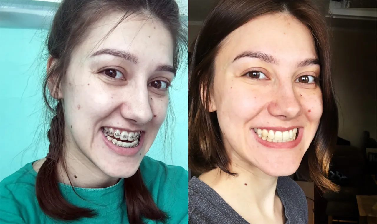aparat ortodontyczny zmiana twarzy przed i po