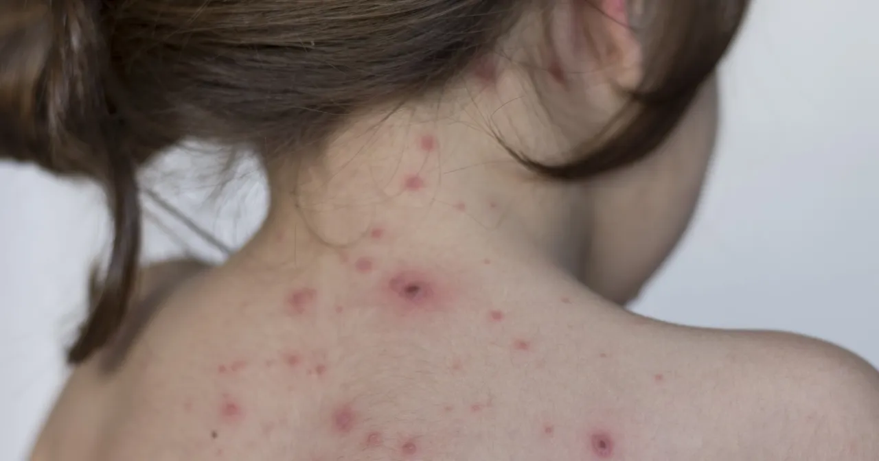 Infografika grupy ryzyka ospa wietrzna