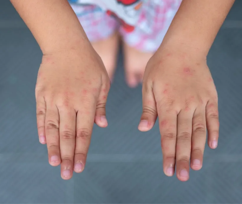 Zdjęcie Czy witamina D3 może uczulać? Rzadkie reakcje alergiczne u dzieci