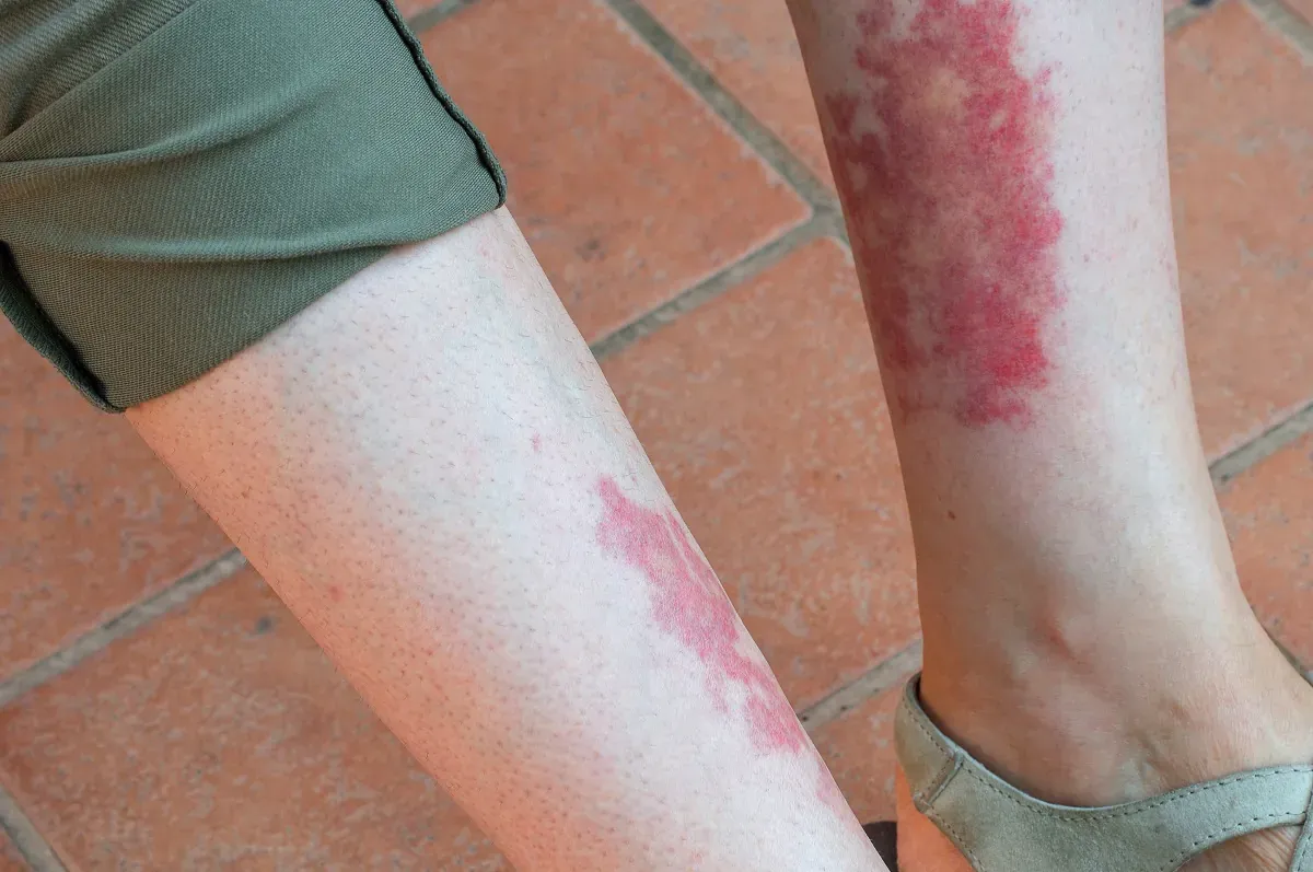 Objawy chorób naczyniowych