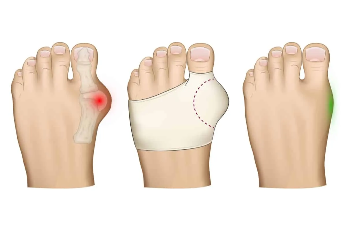 anatomia haluksa i palucha koślawego