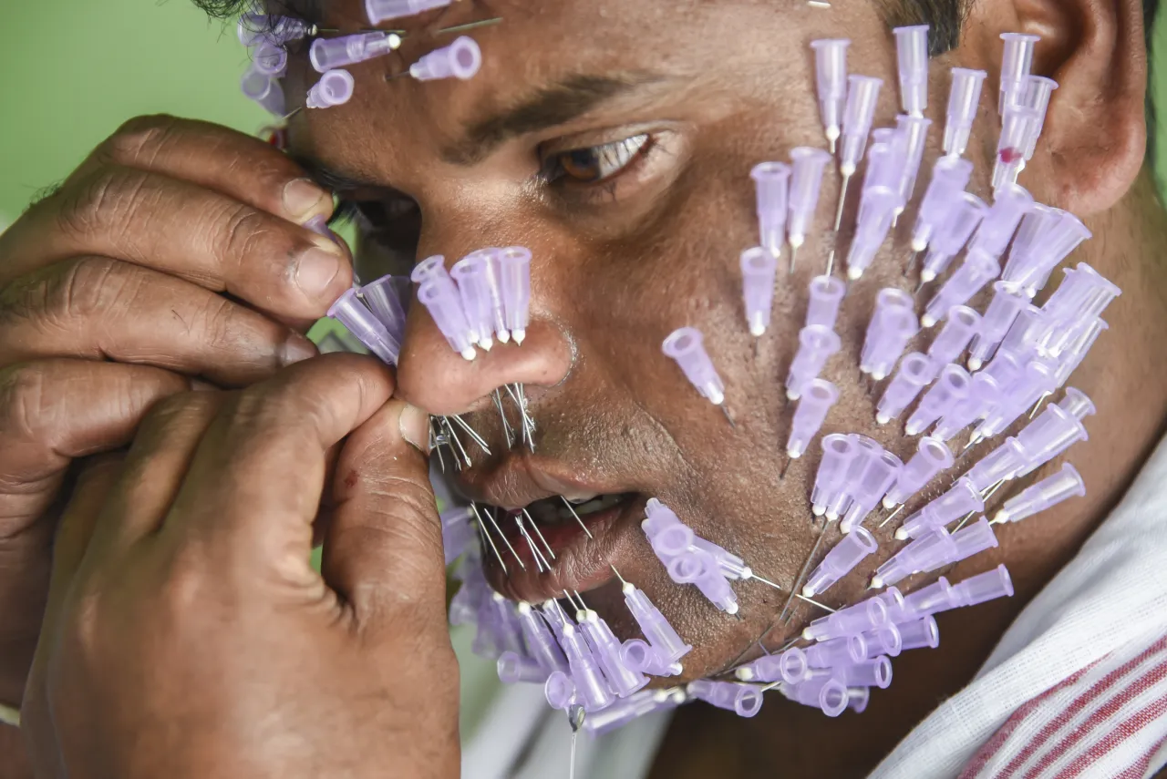 Rodzaje igieł do akupunktury kosmetycznej