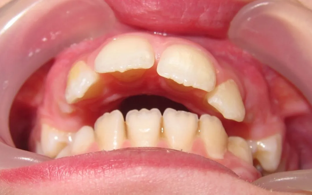 dziecko u ortodonty, wady zgryzu u dzieci przykłady