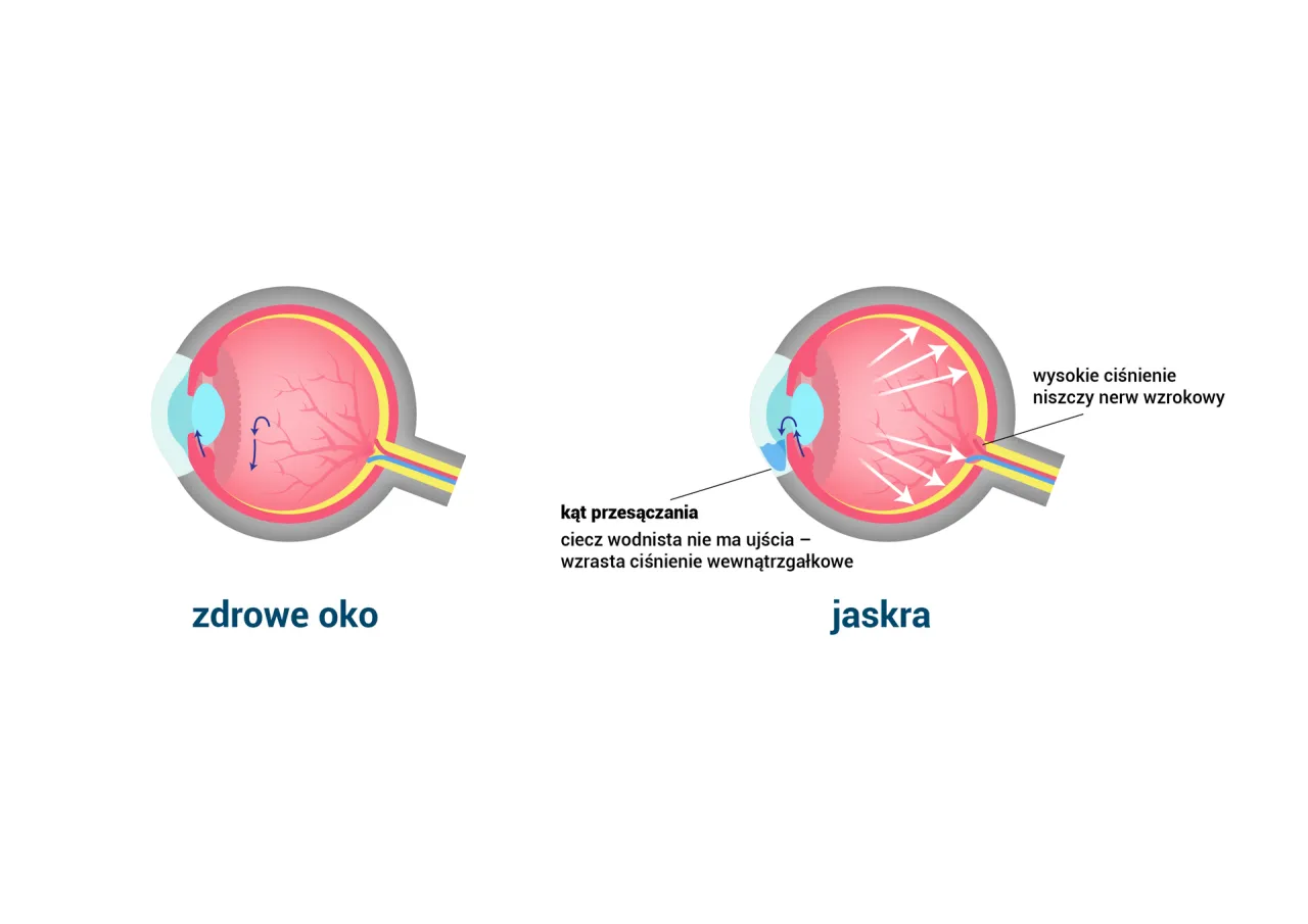 anatomia oka jaskra uszkodzenie nerwu wzrokowego