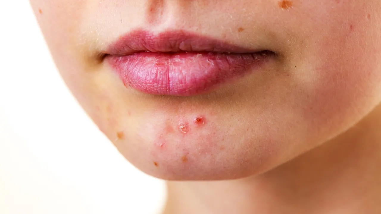 zapobieganie bliznom po trądziku