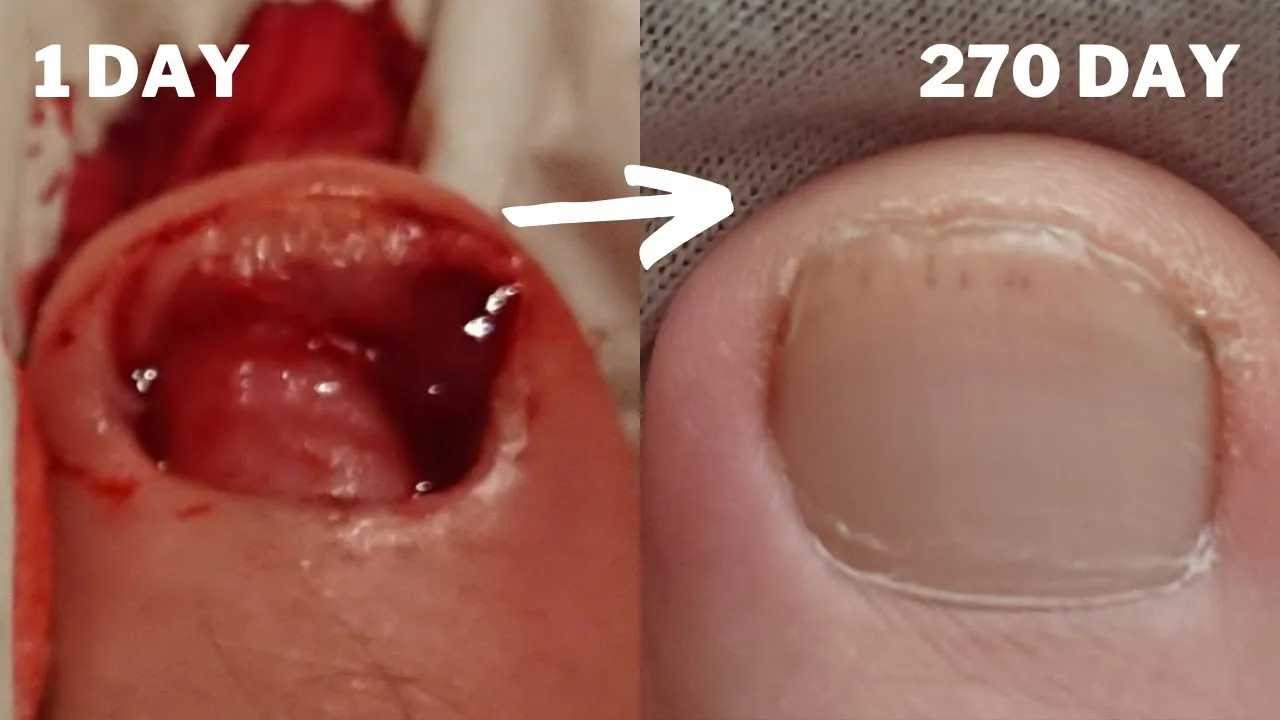 odrastanie paznokcia po urazie