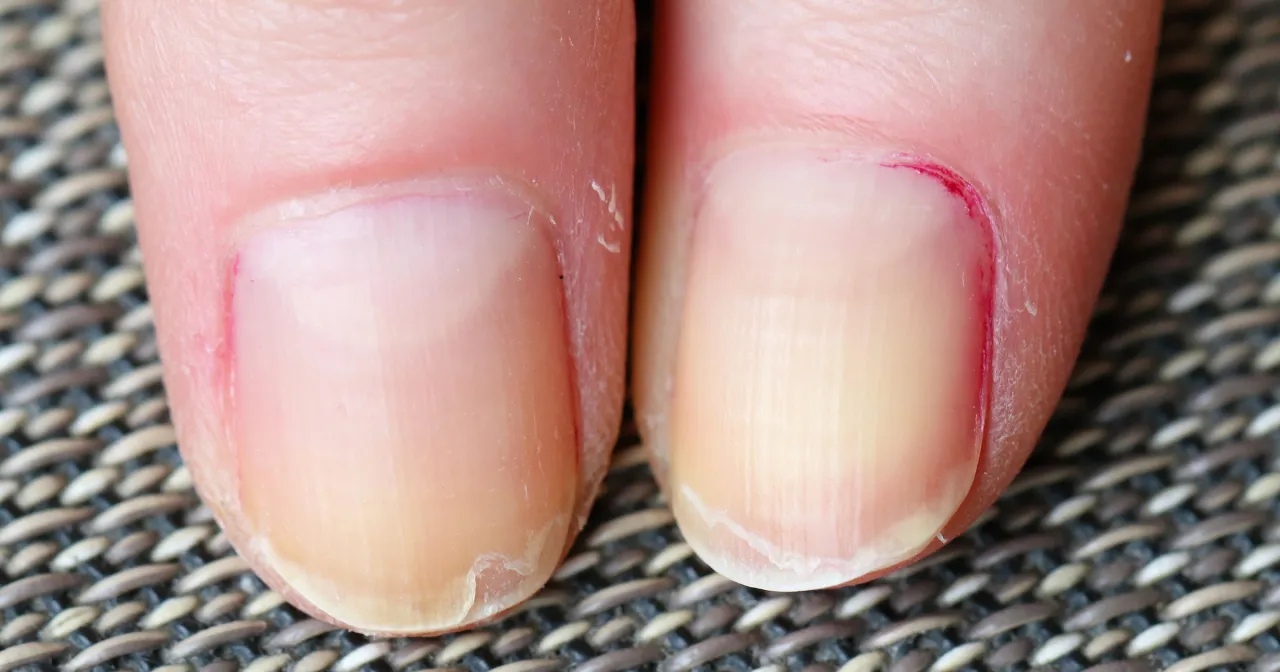 objawy niedoboru białka skóra włosy paznokcie