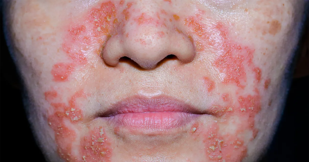 verschiedene hautkrankheiten gesicht