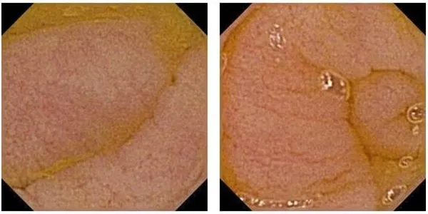 gastroskopia z biopsją jelita cienkiego celiakia