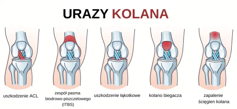 mapa b&oacute;lu kolana biegacza
