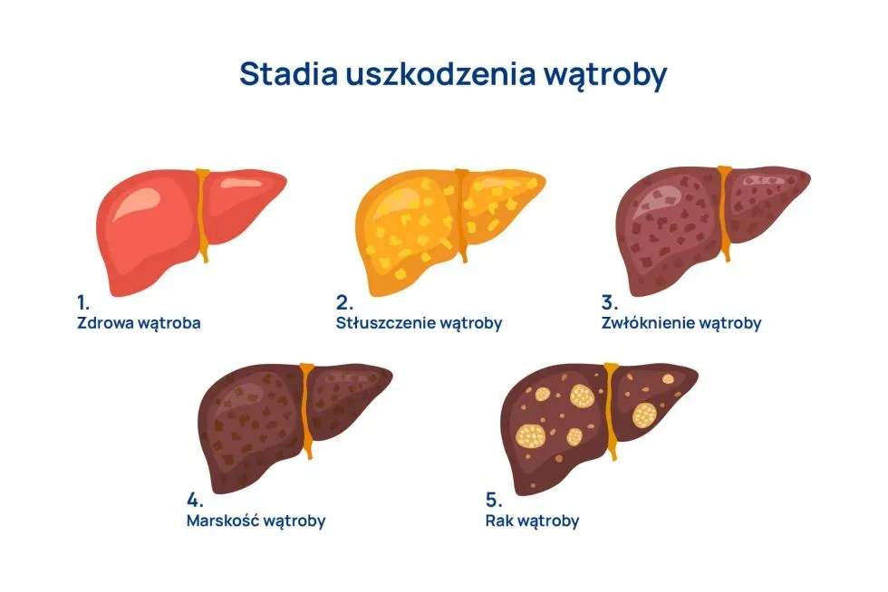 przyczyny uszkodzenia wątroby, stłuszczenie wątroby