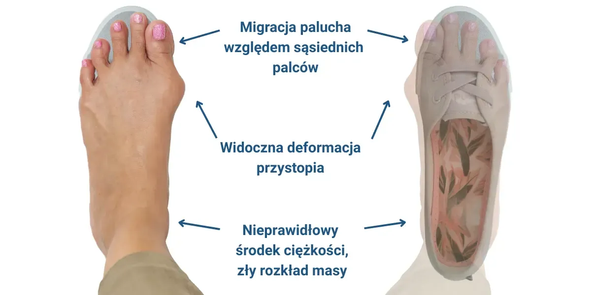 buty na haluksy cechy budowa